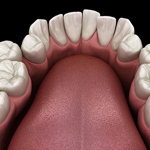 Illustration of crooked teeth