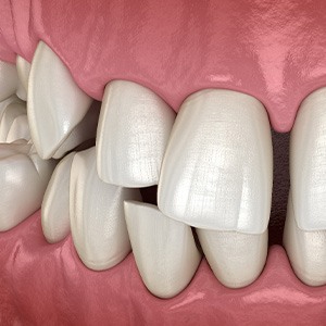 Illustration of gapped teeth