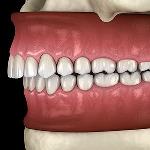 Illustration of an overbite