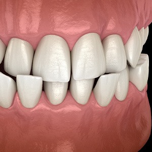 Illustration of a crossbite