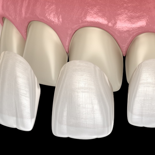 Animated smile during porcelain veneer placement