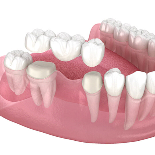 various types of dentures against a white background