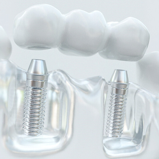 various types of dentures against a white background