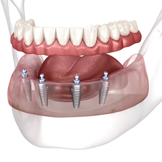 a closeup of implant dentures