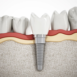 Illustration of dental implant in Dallas in jawbone