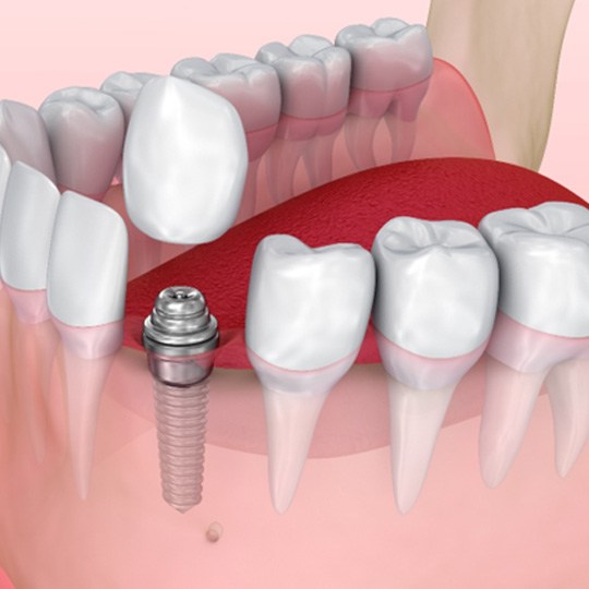 Digital illustration of a dental implant in Dallas