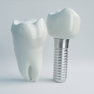 An illustration of implant parts, which affect the cost of dental implants in Dallas
