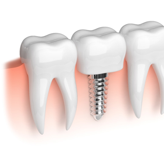 Illustration of a dental implant in Dallas, Tx