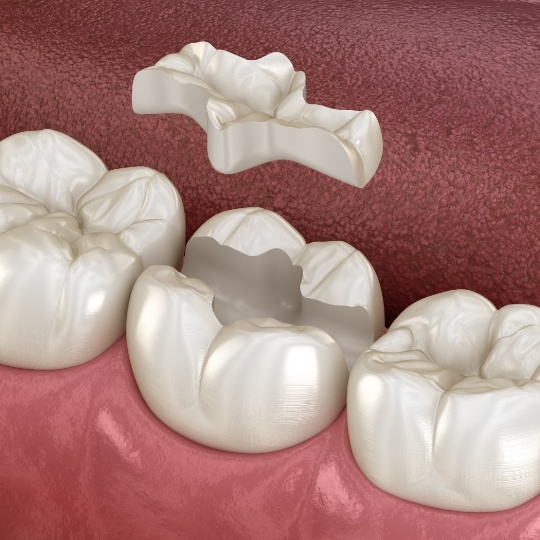 Animated smile during tooth colored filling placement