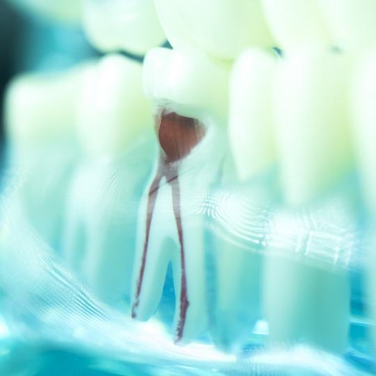 Model tooth demonstrating the results of root canals