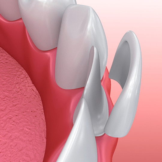 an illustration of the process for veneers in Dallas