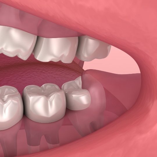 Animated smile with impacted wisdom tooth