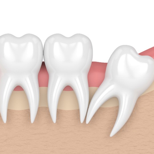 Maan illustration of a wisdom tooth in Dallas