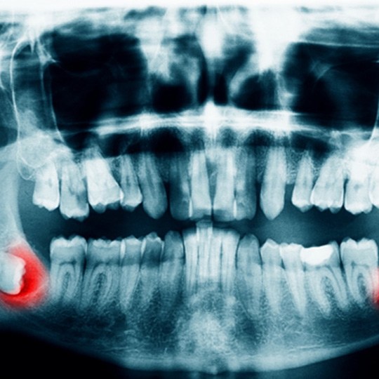 an X-ray of impacted wisdom teeth in Dallas