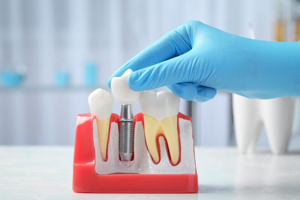 A model of a dental implant