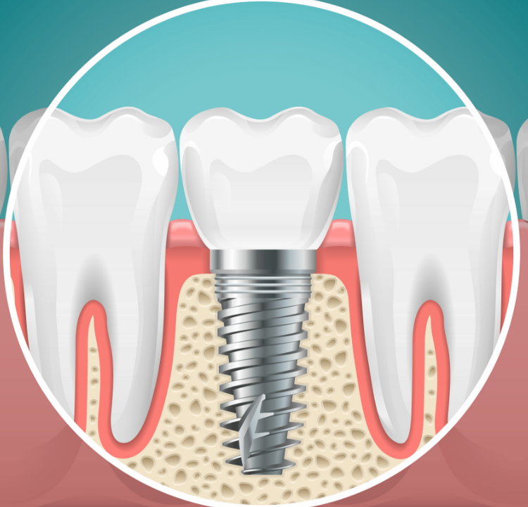 Illustration of a dental implant in cross section