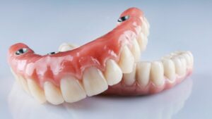 Close-up picture of implant dentures
